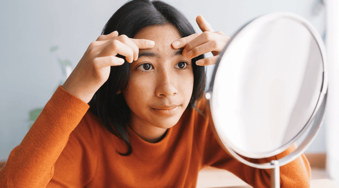 Young woman with acne pimples examining her skin in the mirror